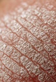 건선 피부염 완전정리