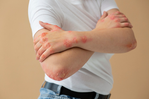 대상포진_증상_예방방법_전염