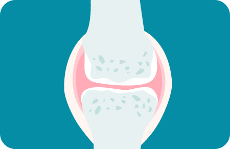 류머티즘관절염