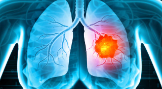 폐암