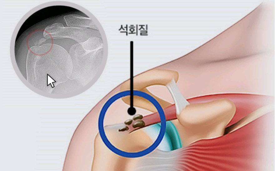 어깨통증 4