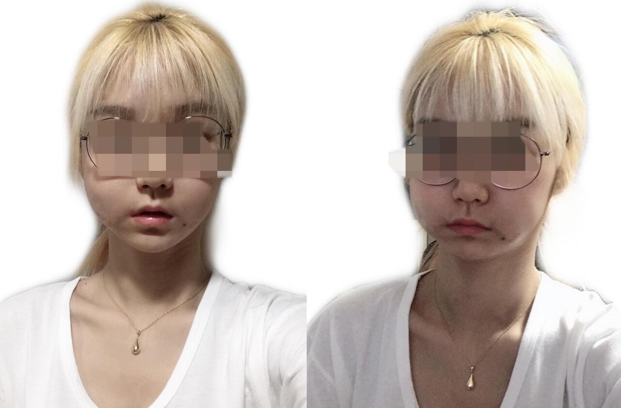 얼굴지방이식후기