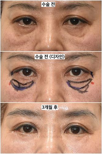 눈밑레이저
