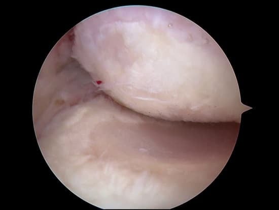 팔꿈치 강직(Elbow Stiffness): 원인, 증상 및 치료 방법