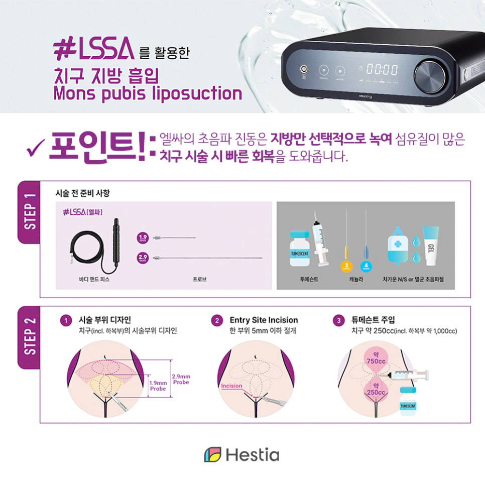 엘싸를 활용한 치구지방흡입