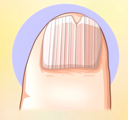 손톱에 세로줄이 생기는 이유