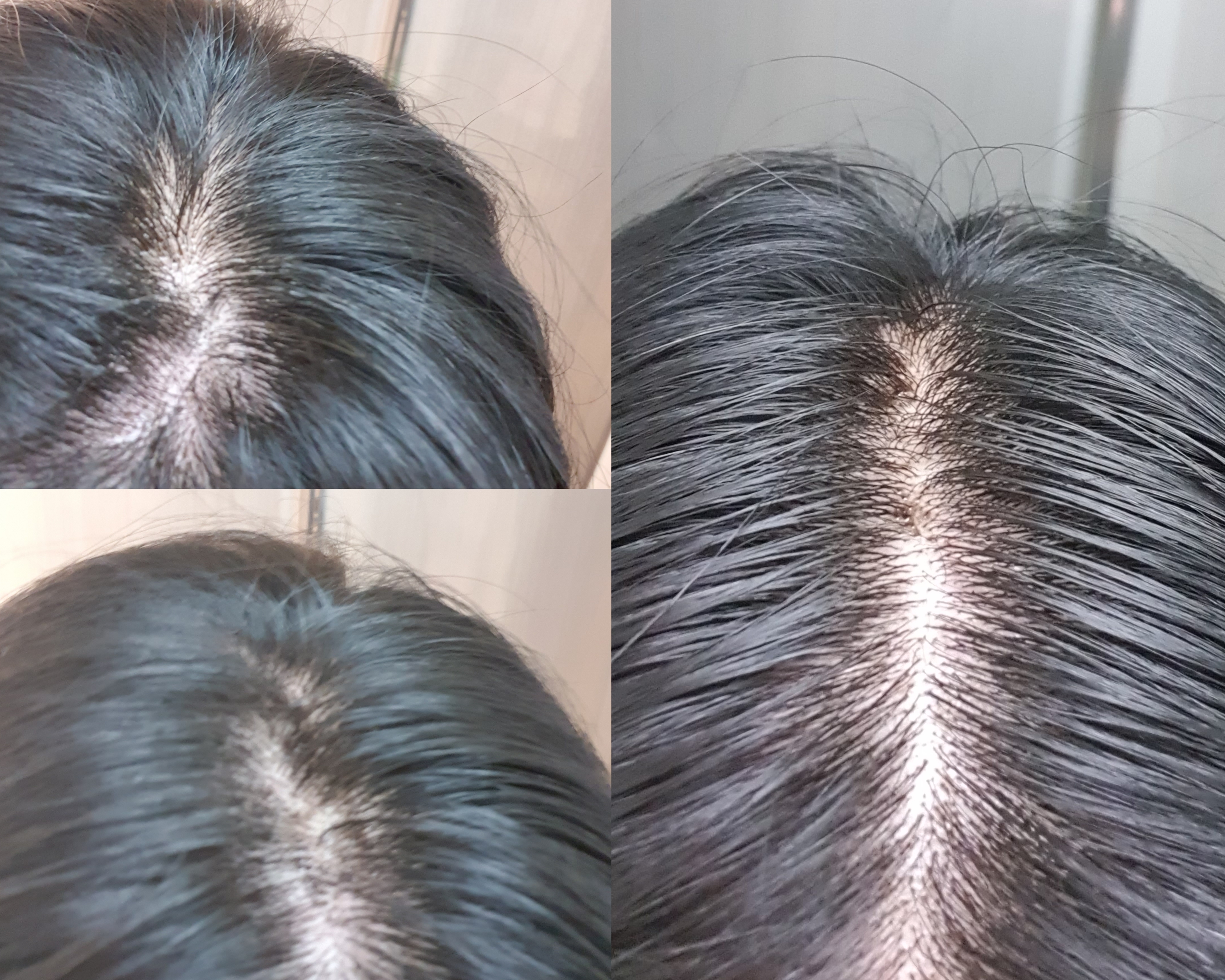 40대 여성 정수리 탈모