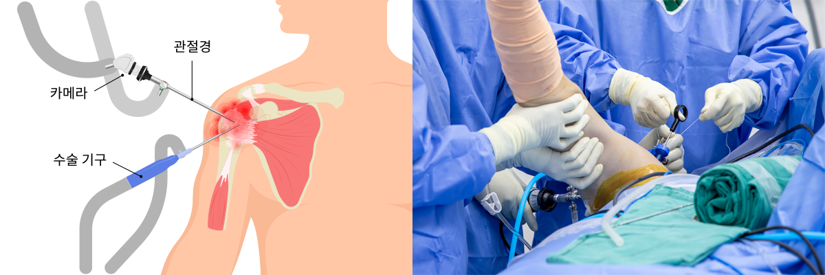관절경수술