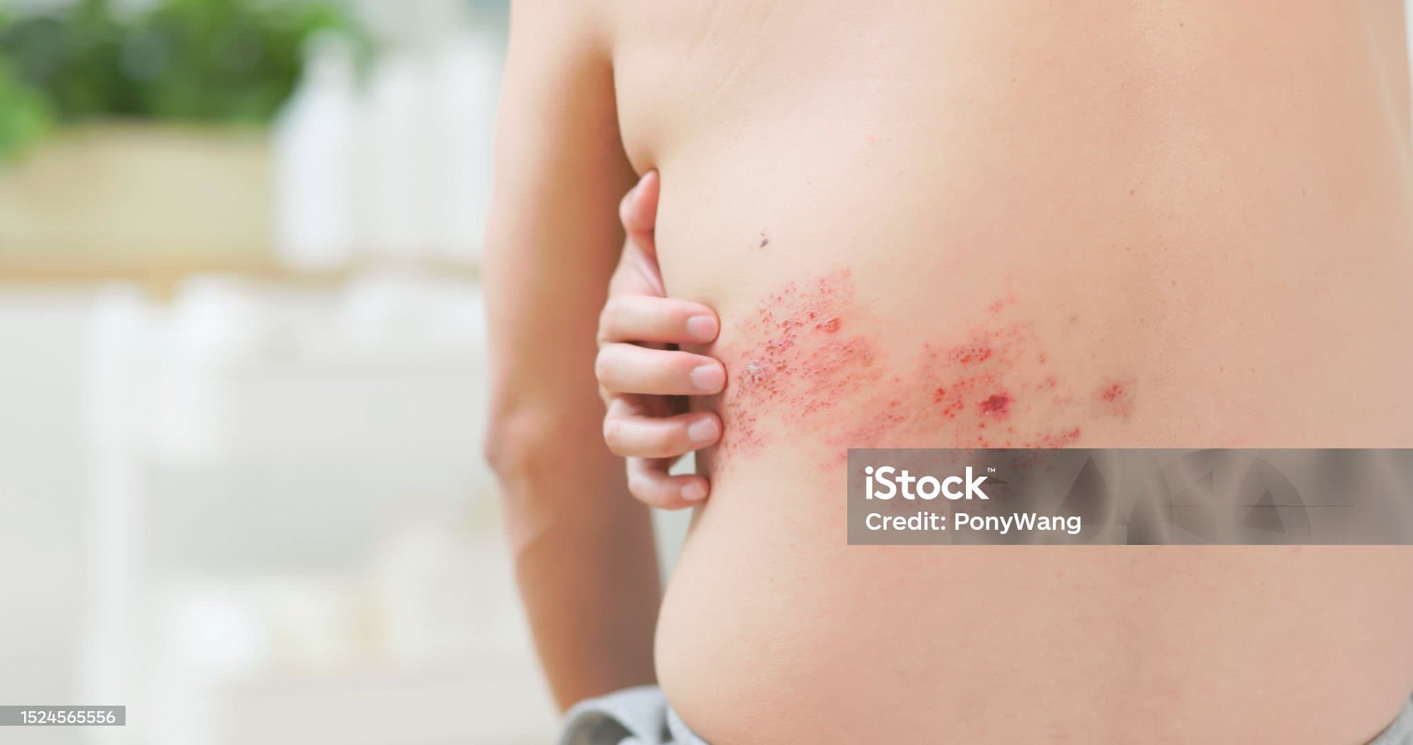 대상포진증상 최신 총정리 초기 징후부터 합병증·치료·예방까지