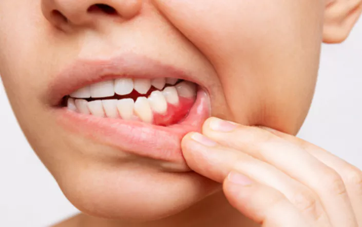 잇몸이-붓고-아플때-이유-해결방법-건강