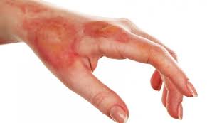 화상 물집 치료방법, 터뜨리지 말고 이렇게 치료하세요!