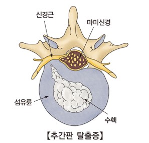추간판 탈출증