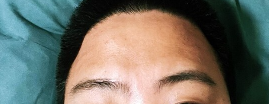 측두근 보톡스