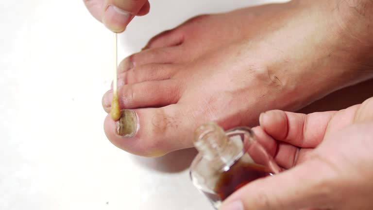 발톱무좀으로 힘든가요? 제대로 치료하는 부산 피부과 찾는법!