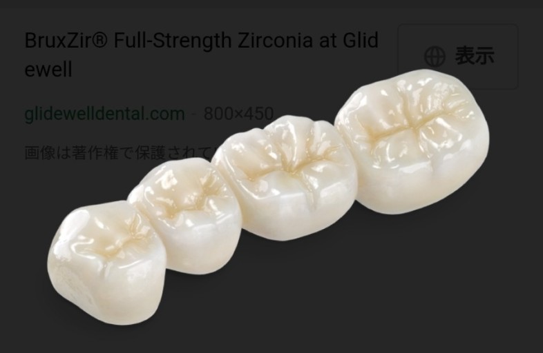 치과 크라운 종류