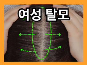 머리카락이 많이 빠지는 이유 - 여성 탈모