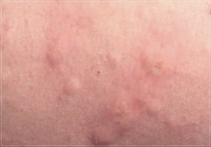 히스타민증후군에 대해 알아보자