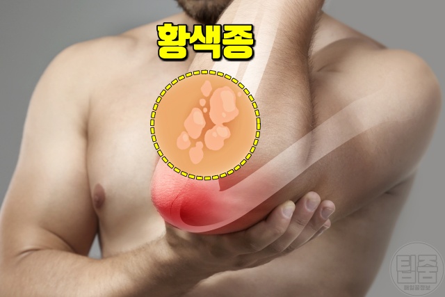 고지혈증 증상 초기증상 팔꿈치 고지혈증원인