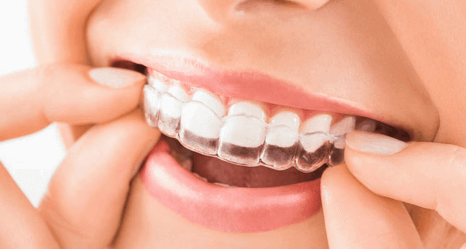 앞니 투명 교정기