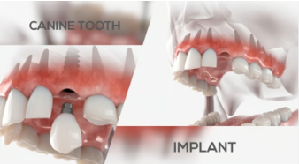 앞니 임플란트 가격