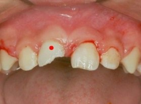 윗이빨이-깨지는-사진