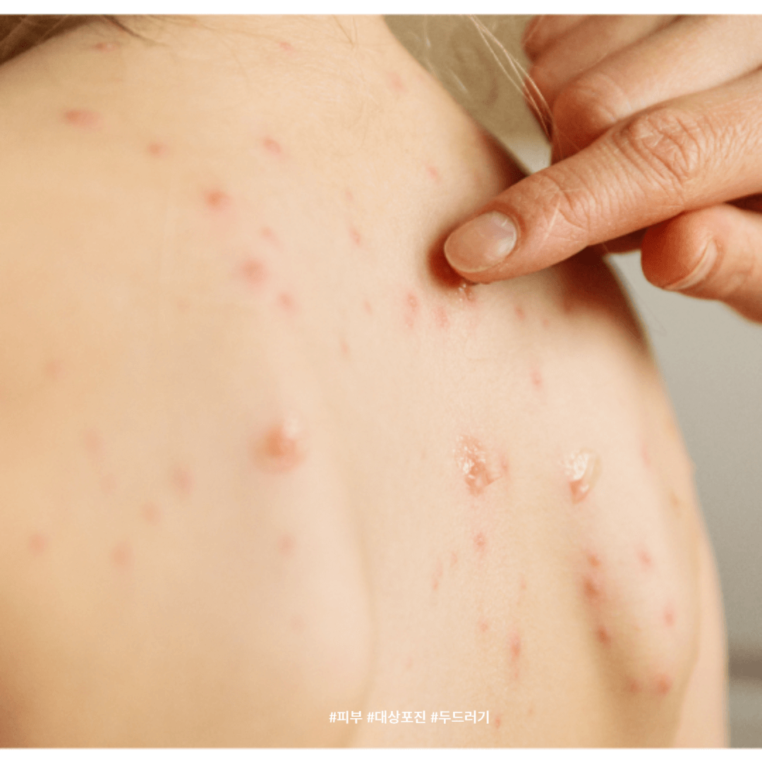 대상포진 단계별 증상과 통증