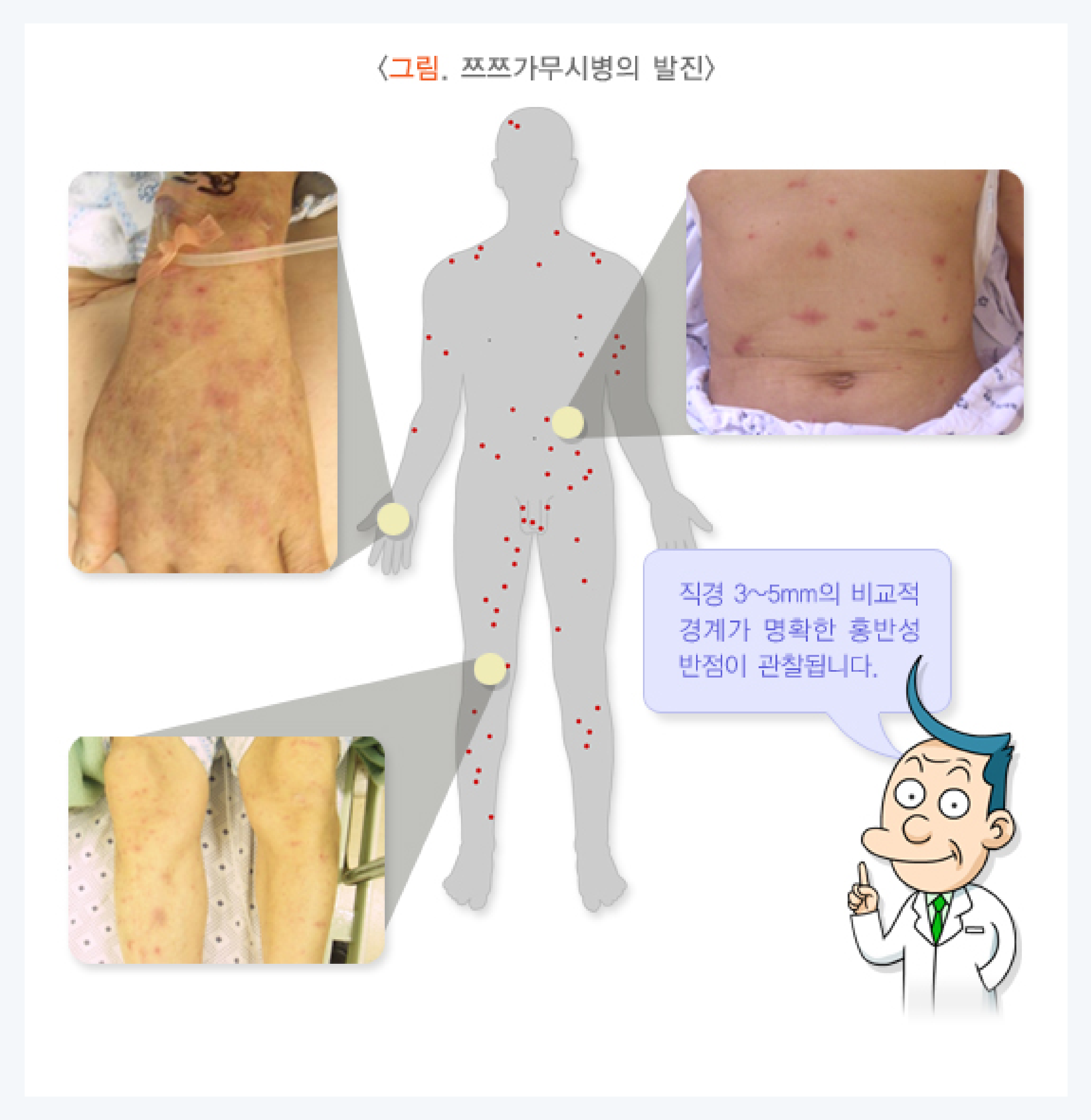 쯔쯔가무시, 진드기