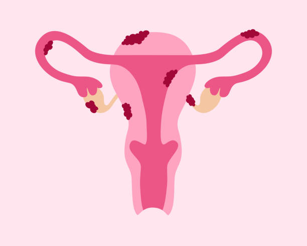자궁내막증 난소 골반 관리 임신 치료 수술 자궁내막 두꺼움 증상 원인 증식증 자궁내막증식증 조직검사 치료 초음파 혈액 검사 복강경