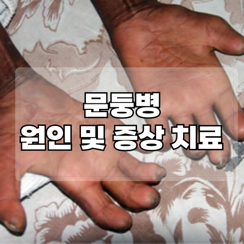 문둥병-원인-및-증상-치료