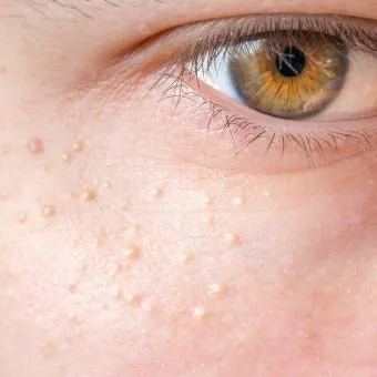 비립종 생기는 이유 비립종 없애는 방법 피부 관리법_32