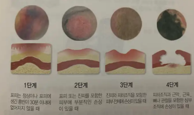 욕창 4단계 그림