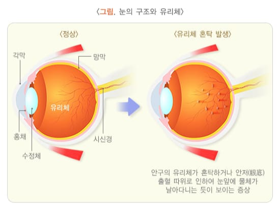 눈의 구조와 유리체