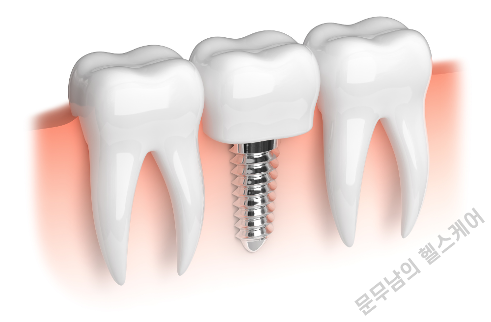 임플란트 시술 과정 기간 통증