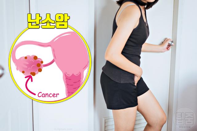 난소암 증상 전조증상 소변 배변