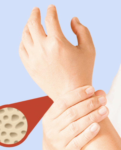 골다공증 치료방법 1