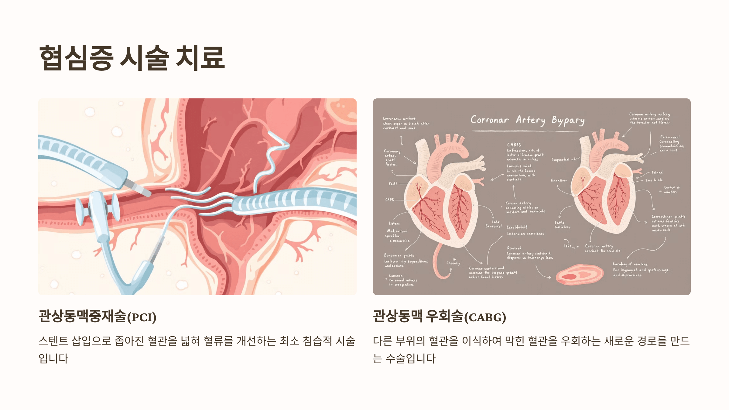 협심증과 관련된 사진입니다.