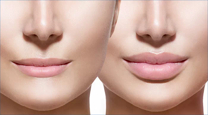 입술필러 전후