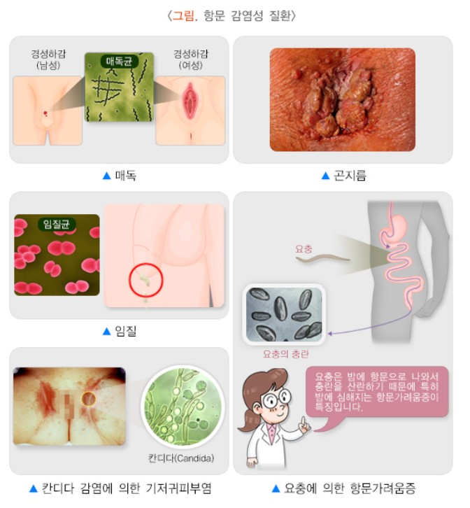 항문 가려움증, 당신이 알아야 할 5가지 사실