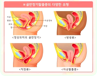 여성 방광류 교정수술, 꼭 알아야 할 회복 관리 5가지