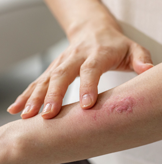 대상포진 초기증상 1