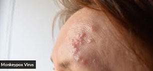 이마에 발진이 일어났다