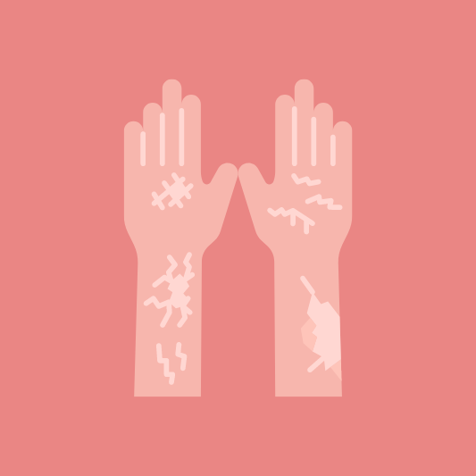 건선-이미지-예시