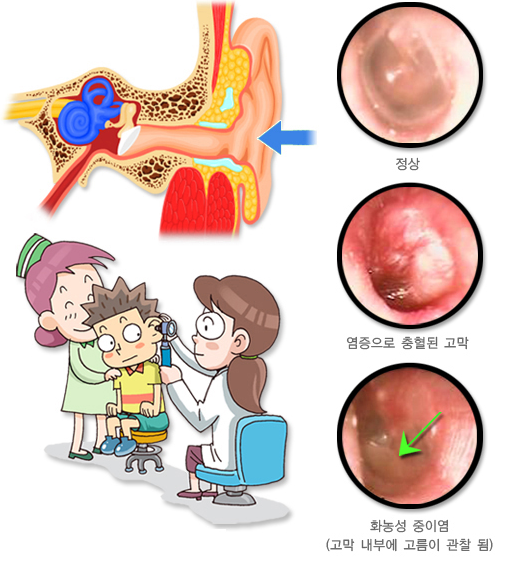 중이염 검사 사진