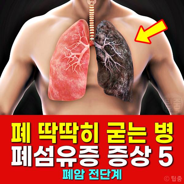 폐 굳는 병 폐섬유증 증상 폐암 전단계 코로나후유증