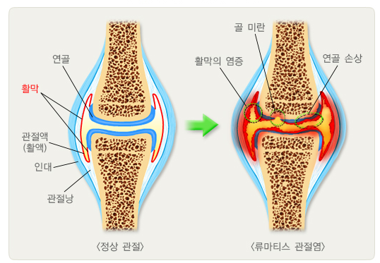 류머티스관절염