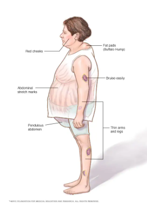 쿠싱증후군 증상
