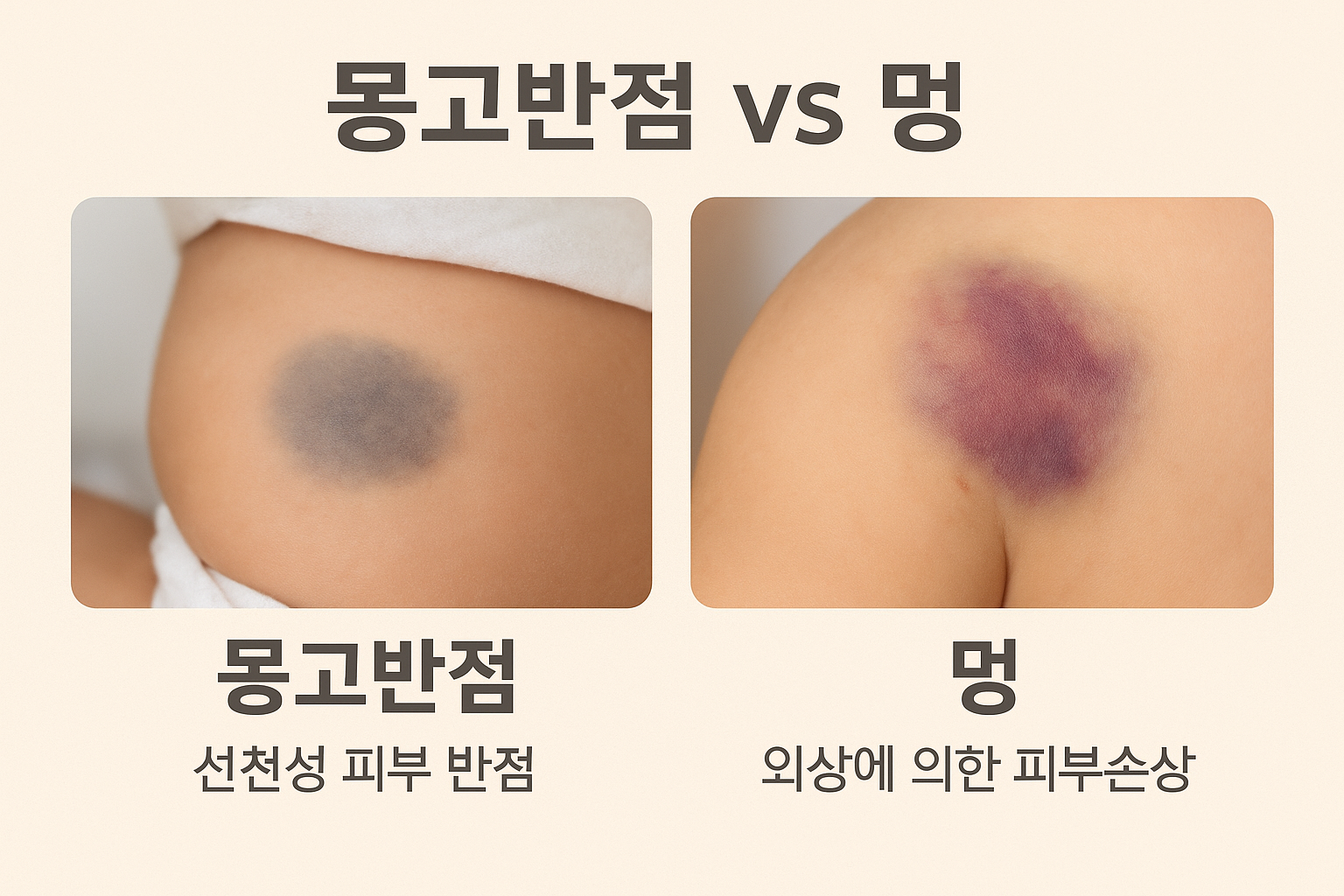 몽고반점과-멍은-차이가-있습니다.