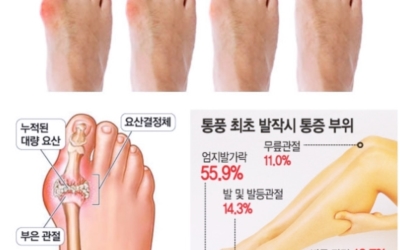 통풍 사진