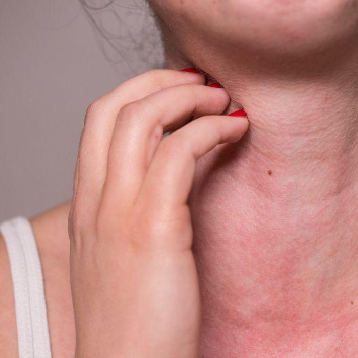 알레르기 가려움