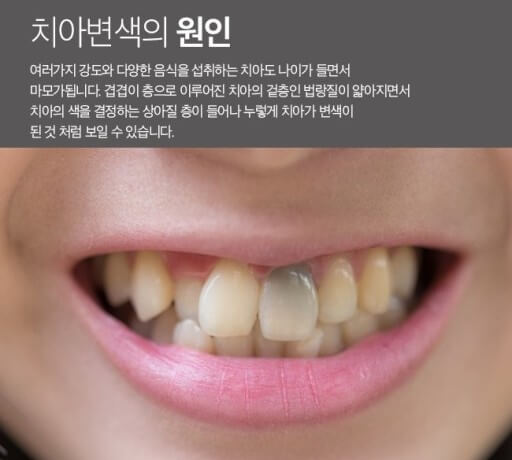 치아변색